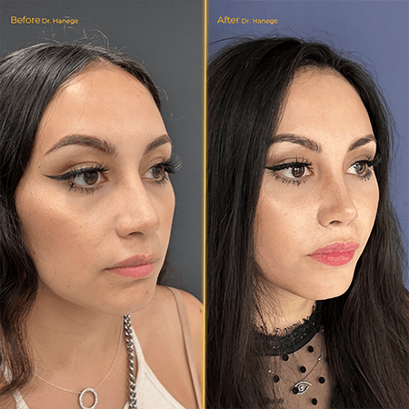 Rhinoplasty Before/After