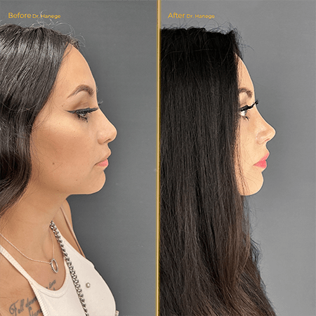 Rhinoplasty Before/After
