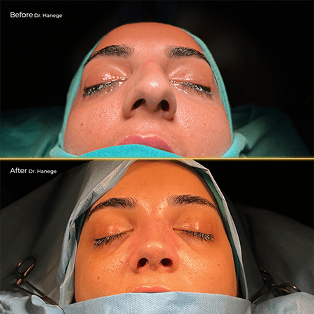 Rhinoplasty Before/after