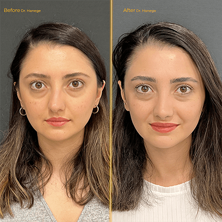 Rhinoplasty Before/after 