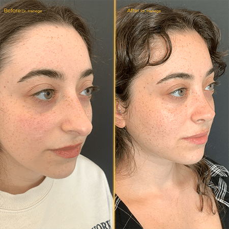 Rhinoplasty Before/after