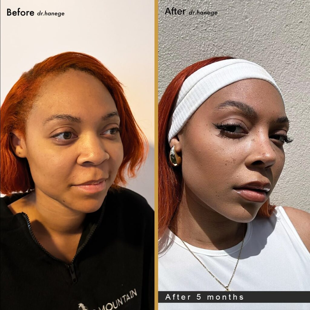 ethnic rhinoplasty turkey