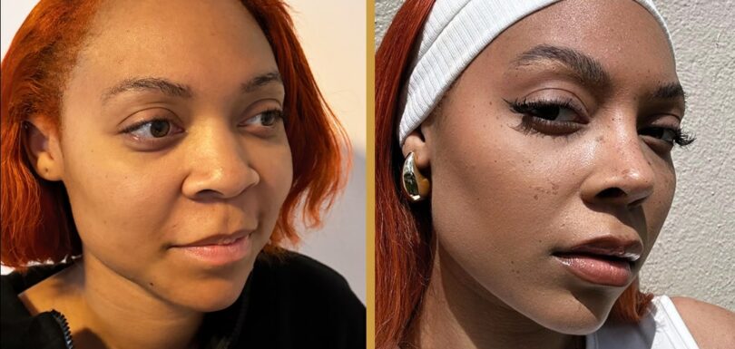 ethnic rhinoplasty turkey