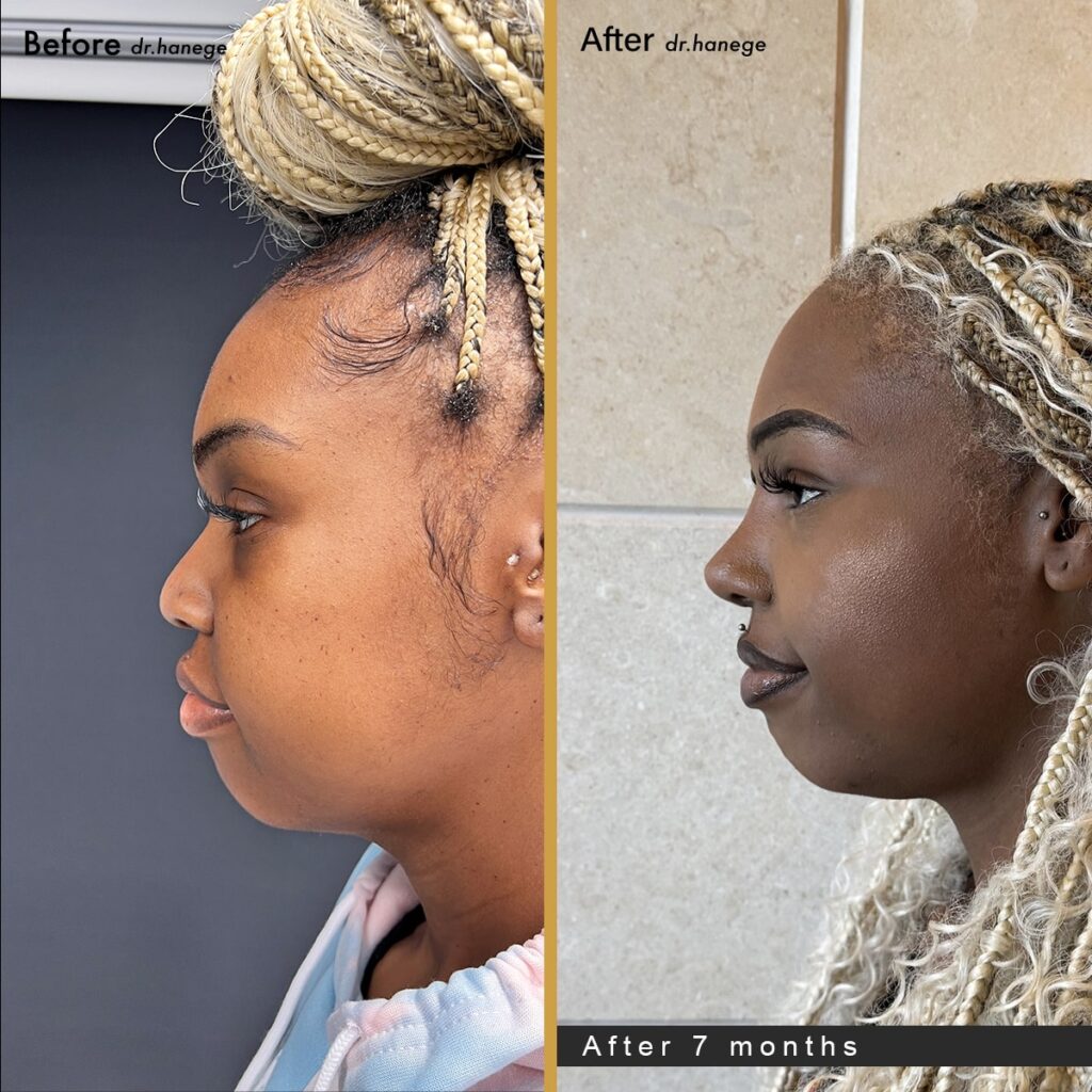 ethnic-rhinoplasty-istanbul