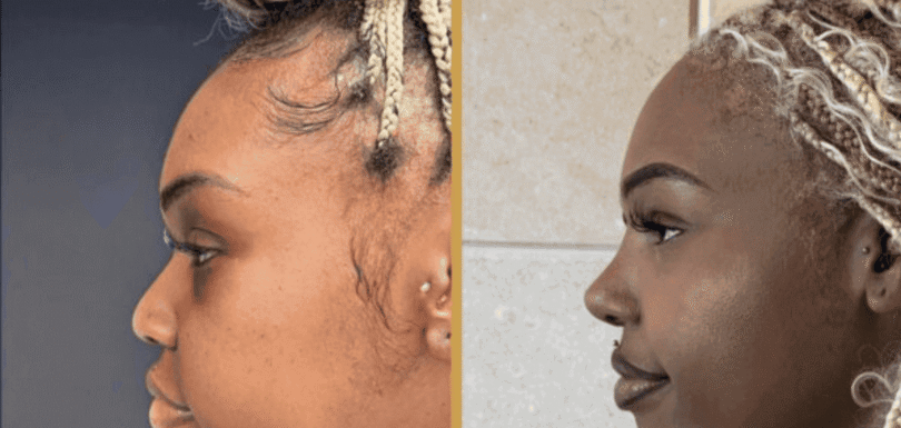 ethnic rhinoplasty turkey