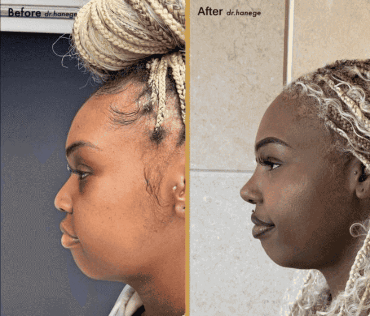 ethnic rhinoplasty turkey