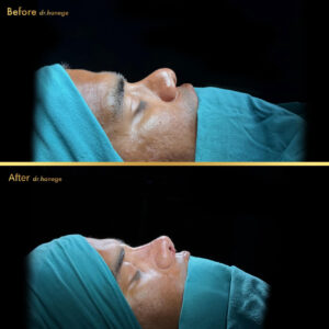 ethnic revision rhinoplasty