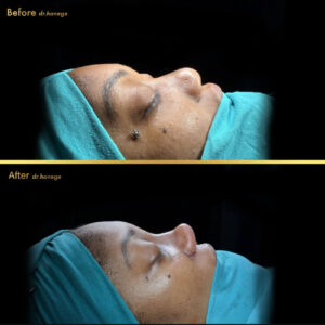 revision rhinoplasty turkey