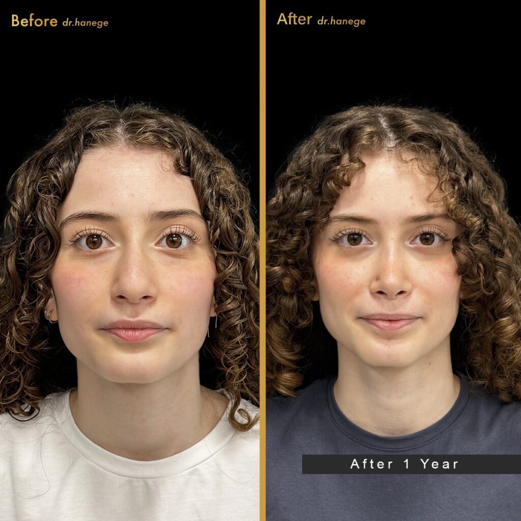 rhinoplasty trends 2025