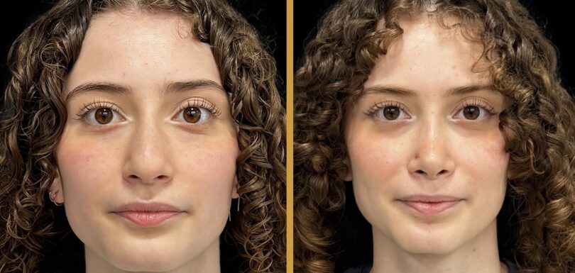 rhinoplasty trends 2025