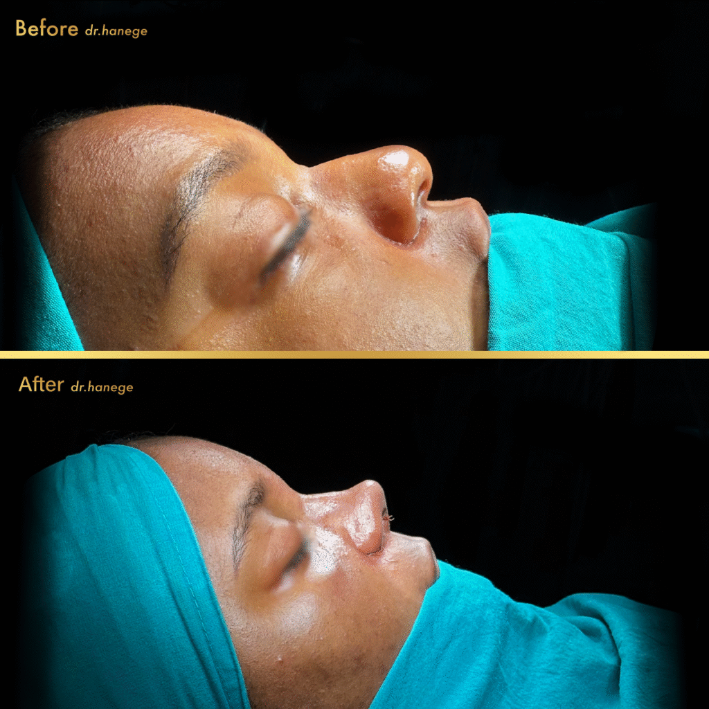 Ethnic Rhinoplasty Before After