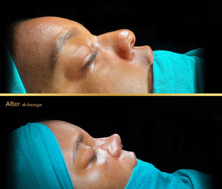 Ethnic Rhinoplasty Before After