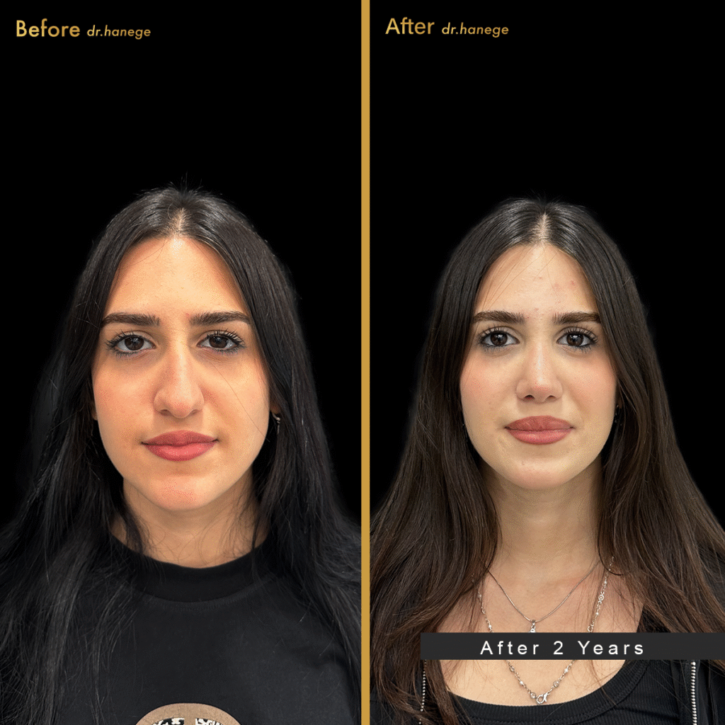 7-Essential-Facts-About-Nose-Cover-After-Surgery