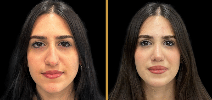 7-Essential-Facts-About-Nose-Cover-After-Surgery