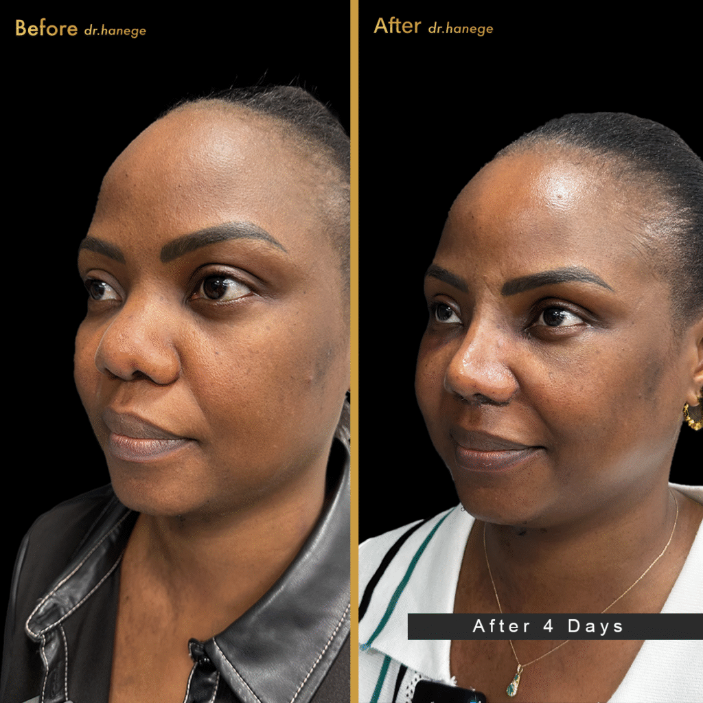 Ethnic Rhinoplasty in Istanbul