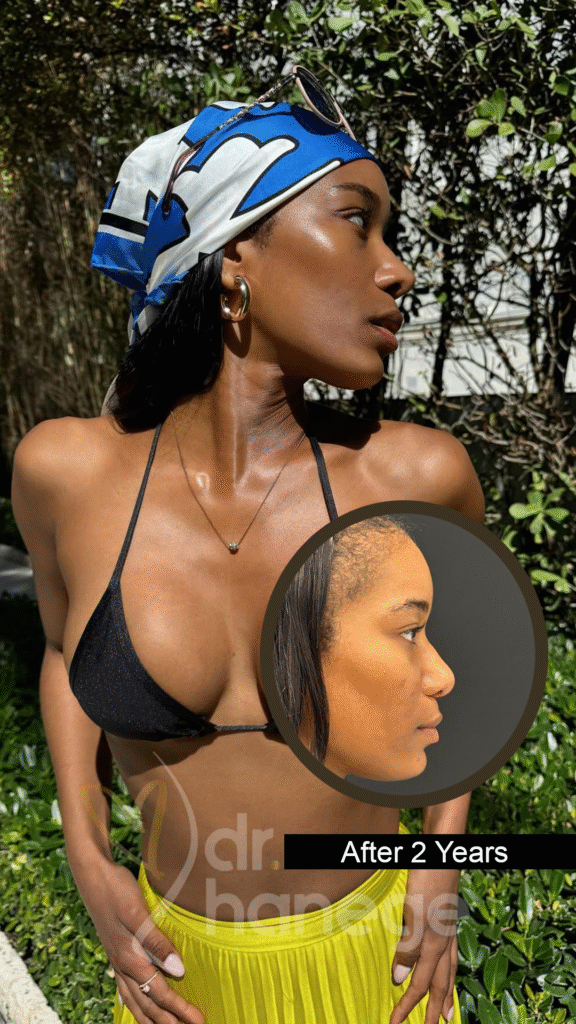 7 Key Facts About Ethnic Rhinoplasty in Istanbul