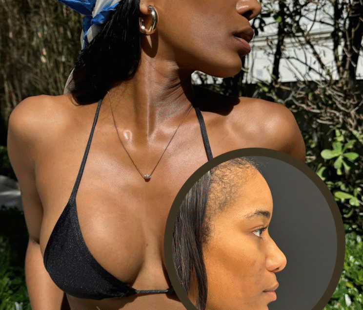 7 Key Facts About Ethnic Rhinoplasty in Istanbul