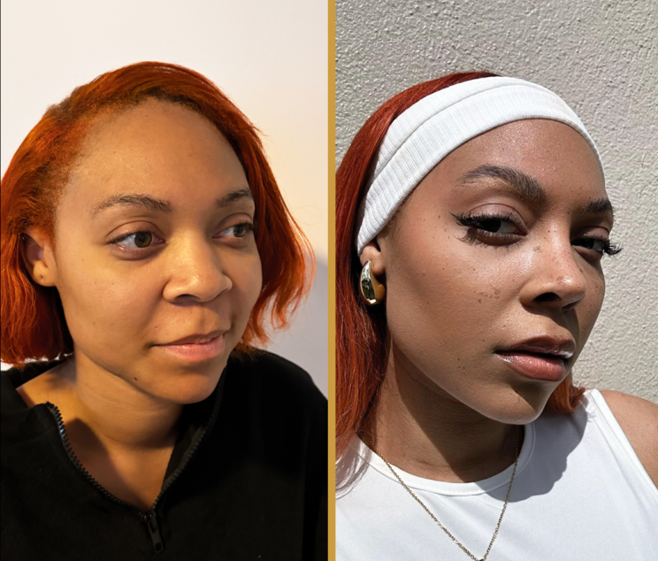 ethnic_rhinoplasty_in_istanbul