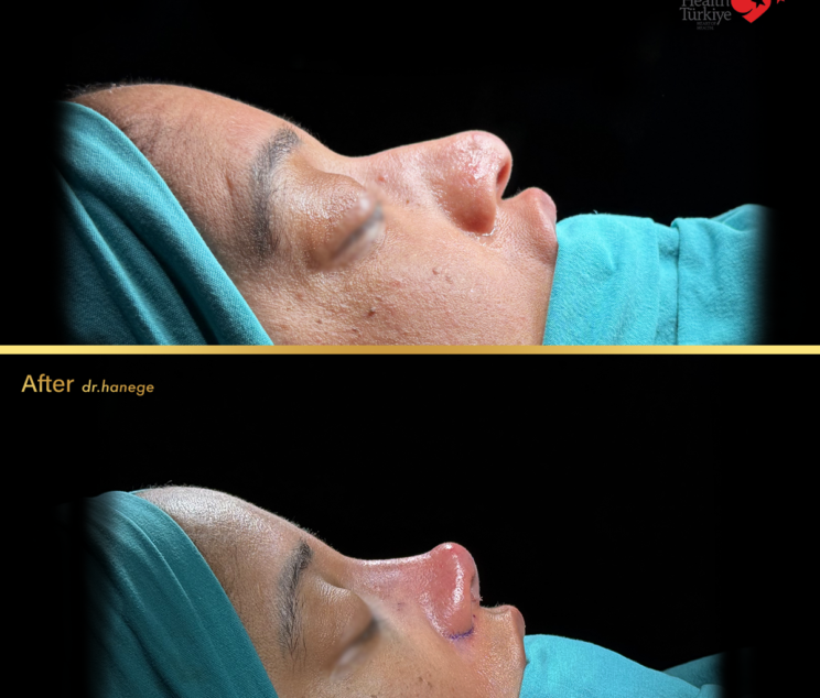 ethnic rhinoplasty
