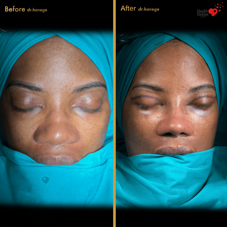 Rib Cartilage Rhinoplasty: Why Surgeons Use Rib Grafts in Complex Nose ...