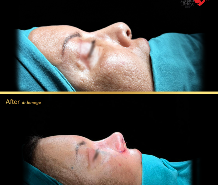 revision rhinoplasty